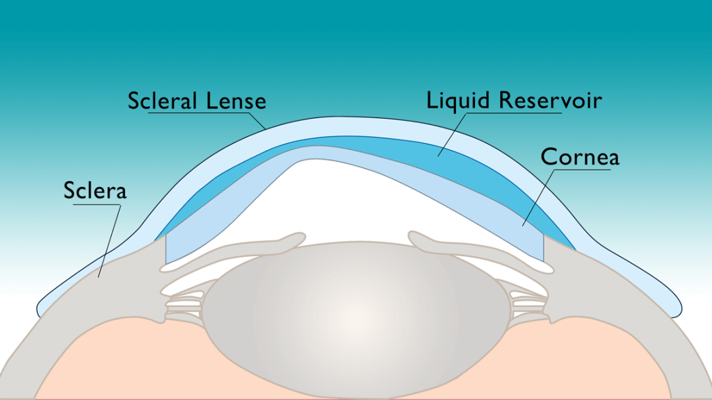 Scleral Contact Lenses - Looking Glass Optical