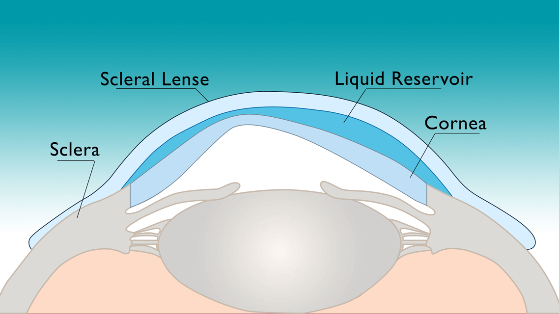 scleral lens flexture