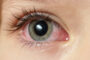 Debunking Pink Eye Myths: What You Need to Know